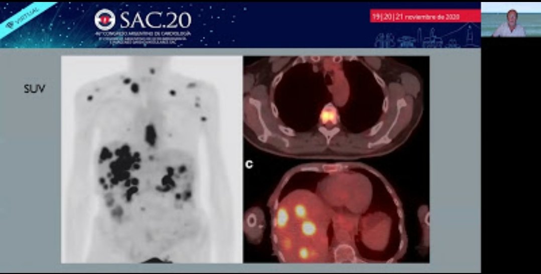SACnuclear's tweet photo. #SAC20 ⏰ #AHORA Grierson
♨️ Imagenes en el estudio de Tumores y fuentes emboligenas
🎤Dr. Marcelo Rodrigues
➡️ Valoracion de Masas Cardiacas mediante PET
#SAC20 @sac_hit @SAC_54
@SACnuclear @CardiOncoSAC #Cardionuclear @NeivaMaciel_doc
@consejoEcoSAC https://t.co/GjG1Ak4uwA