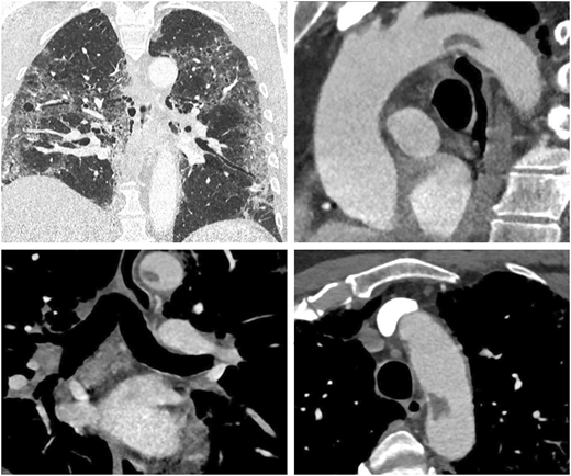 Great vessel #thrombosis as complication of #COVID19 infection by Mosbahi et al. #EJCTS bit.ly/3kLHtVx