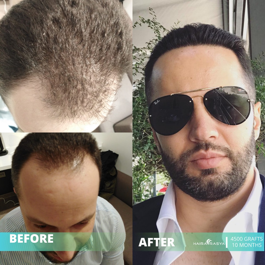 Hairavrasya Hair Transplant on Twitter: Hairavrasya Hair Transplant on Twitter: