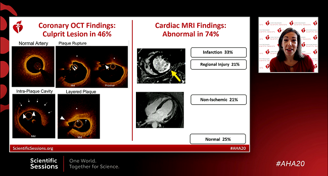 OCT and MRI Find an MI Cause in 85% of Women With MINOCA: HARP  https://bit.ly/334oqQj&nbsp;The findings support a role for OCT on top of CMR, already urged by guidelines. How outcomes might change remains unclear.
