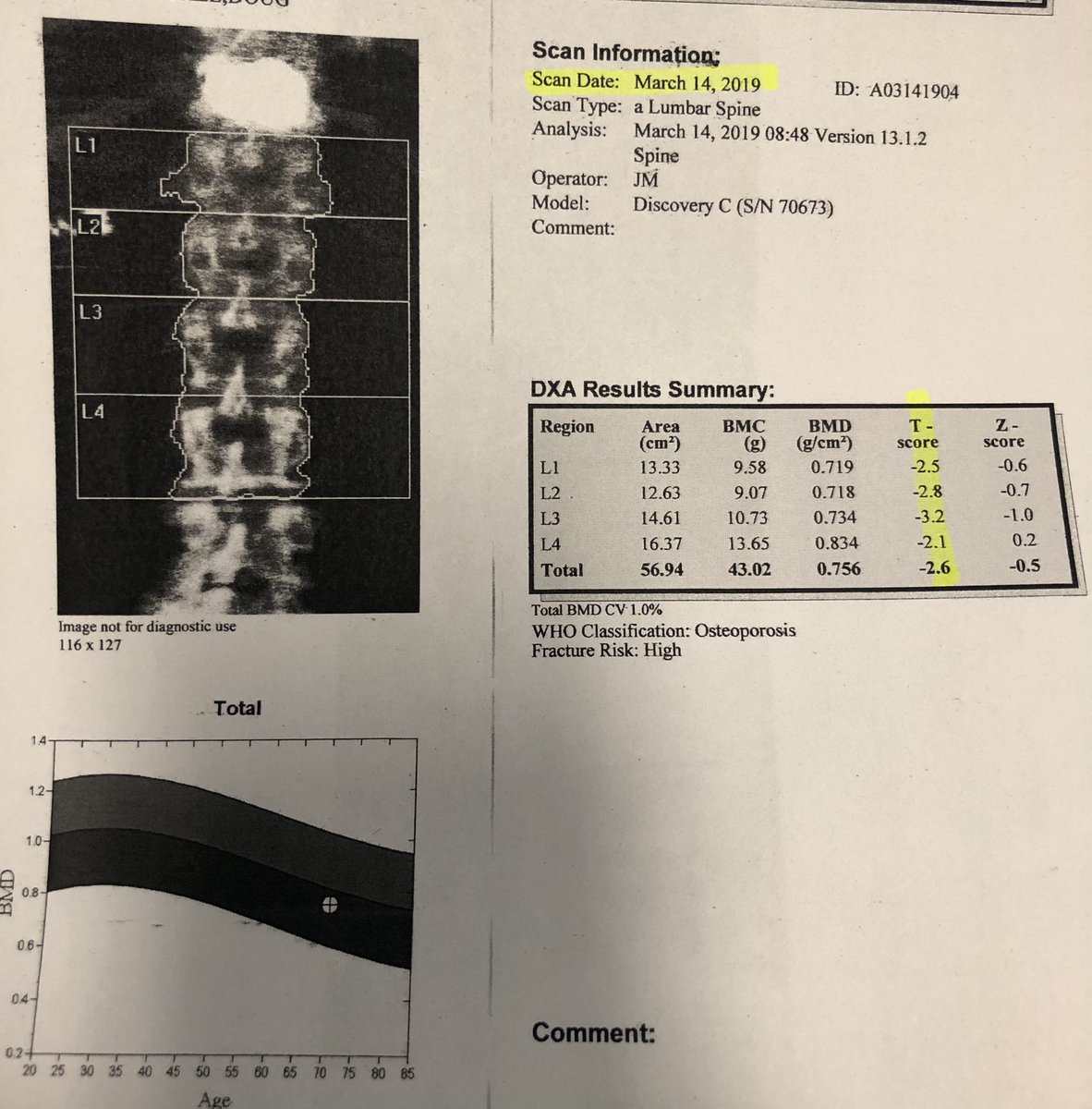 dougbeall's tweet photo. Two years of #Tymlos plus one year of #Evenity. Bone mineral density gain in the spine 29.5%! That’s an unbelievable gain. Osteoporosis solved 👏🏻
@NottsOsteoporo1 @RoyalOsteoSoc @OsteoporosisNOF @TheOsteoCorps @SIRspecialists @ASIPP @TheASNR @PeterEbeling2 https://t.co/QMseI6fg1U