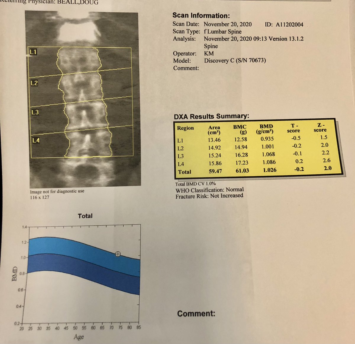 dougbeall's tweet photo. Two years of #Tymlos plus one year of #Evenity. Bone mineral density gain in the spine 29.5%! That’s an unbelievable gain. Osteoporosis solved 👏🏻
@NottsOsteoporo1 @RoyalOsteoSoc @OsteoporosisNOF @TheOsteoCorps @SIRspecialists @ASIPP @TheASNR @PeterEbeling2 https://t.co/QMseI6fg1U