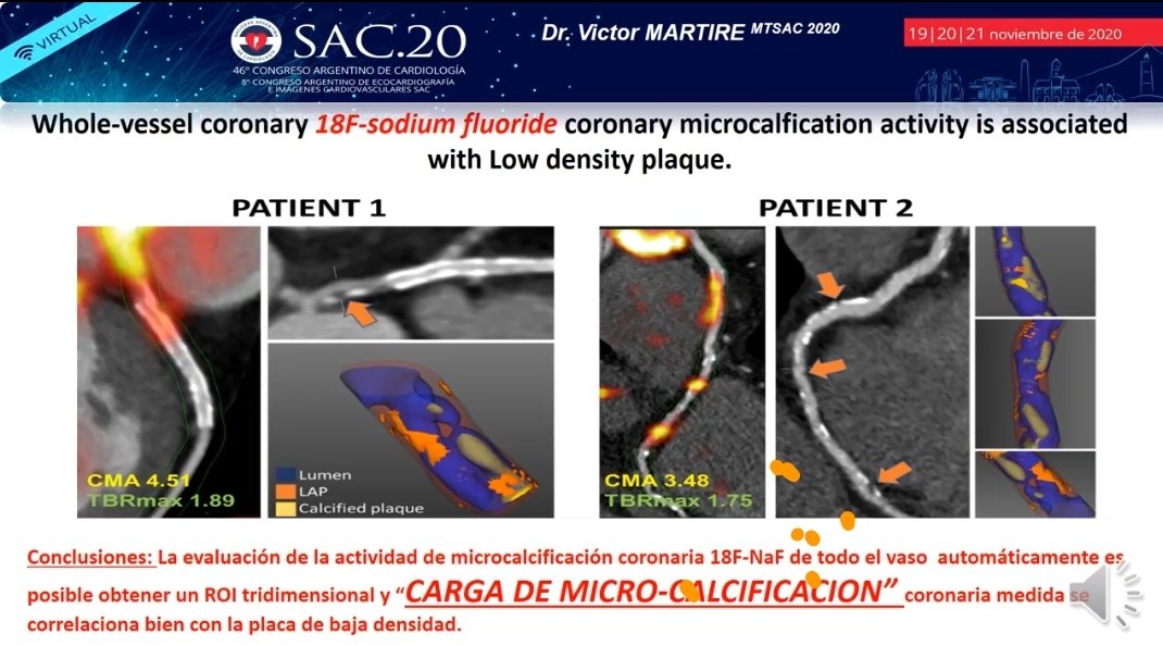 SACnuclear's tweet photo. #SAC20 ❤💯 ESTRATEGIAS DE PREVENCION
📌 Cambios moleculares evidenciables x PET
📌SI !! YES!! Se puede identificar placas vulnerables con PET.✅
🎤 Dr. Victor Martire #CARDIONUCLEAR
@sac_hit @SAC_54
@SACnuclear @AacNuclear
@NeivaMaciel_doc https://t.co/zZZhUQMKhk
