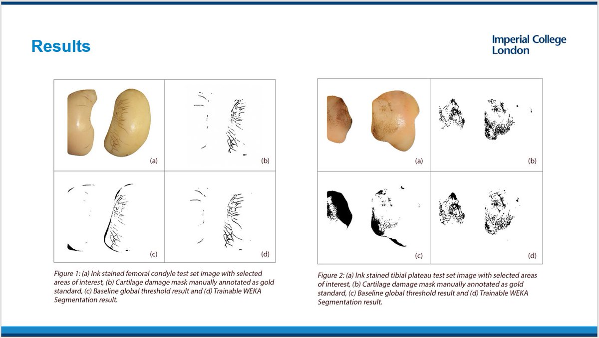 mk_bartolo's tweet photo. Thanks to @ISTA_meeting for the opportunity to present our work on a Machine Learning Approach for Measuring Articular Cartilage Damage in the Knee, in collaboration with @ICBiomechanics and @OrthonikaMedtec 

#ISTA2020 https://t.co/M5xQGEK5ME