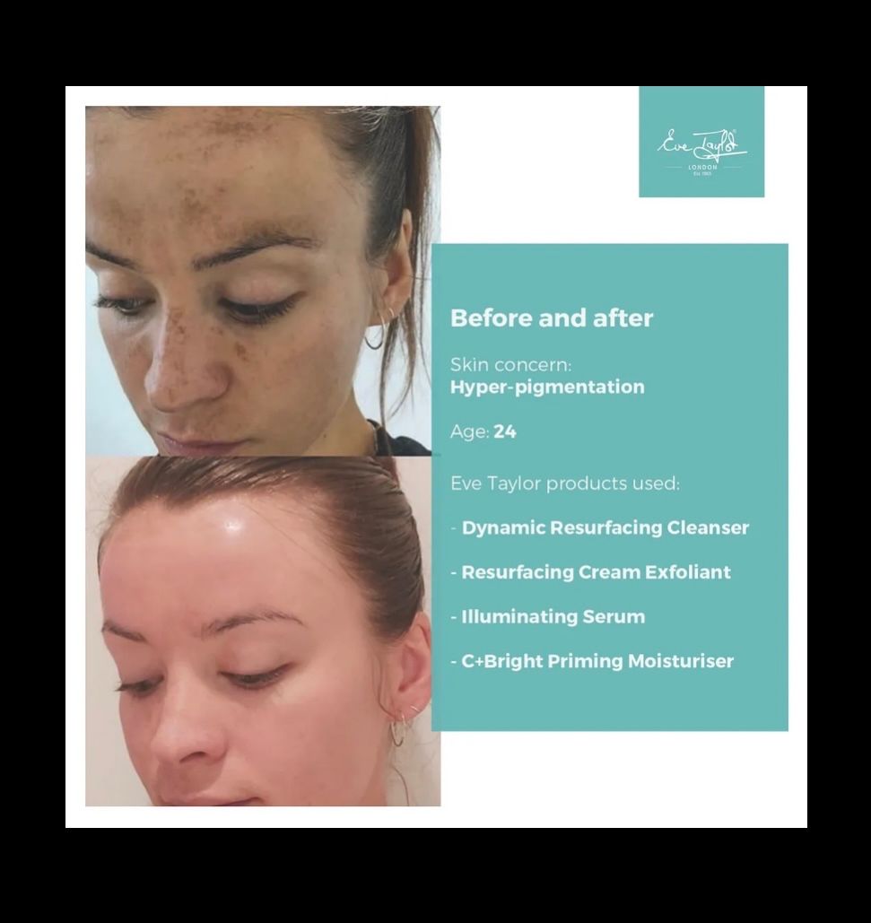 Another incredible result using the 💯 naturally products from #evetaylor
Give me a call to get your unique online skin consultation booked in now on 07979366317
#evetaylorlondon #evetaylorproducts #evetaylorskincare #evetayloraromatherapy #emsworth #skincare #naturalbeauty