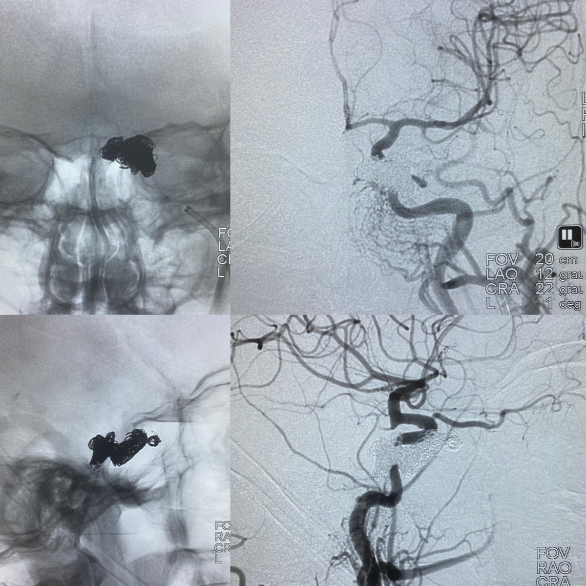 Daniel Abud (@neuroabud) on Twitter photo Arm only arterial and venous approach to treat a dural AVF of the cavernous sinus. Less is more. #RadialFirst <a href="/Starkeneurosurg/">Starke_neurosurgery</a> <a href="/DoctorGaldamez/">Mario MartĂnez-GaldĂĄmez</a> Arm only arterial and venous approach to treat a dural AVF of the cavernous sinus. Less is more. #RadialFirst <a href="/Starkeneurosurg/">Starke_neurosurgery</a> <a href="/DoctorGaldamez/">Mario MartĂnez-GaldĂĄmez</a>