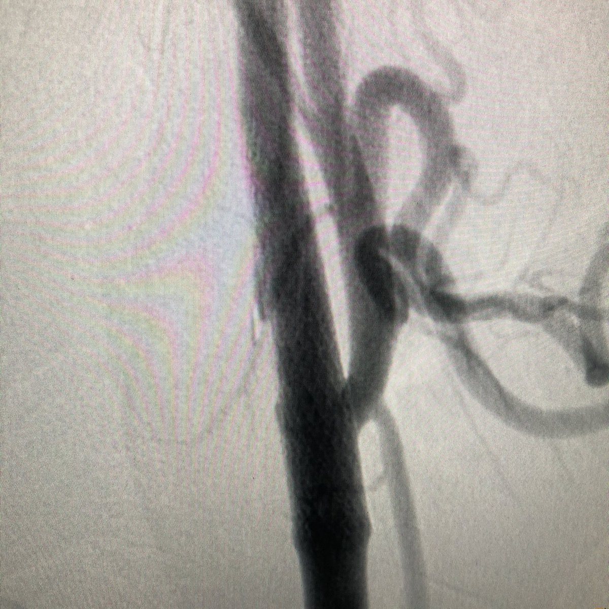 Angioplasty stenting of this symptomatic right carotid web (2 TIAs) by snuffbox TR access. Brazilian team of #radialfirst #RadialforNeuro 🇧🇷