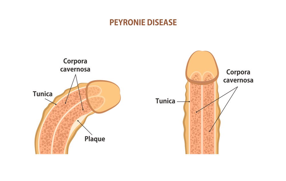 It is usually an emergency so it needs prompt treatment! However if left untreated can further lead to a deformity in the shape of the penis called *Peyronie’s disease! This occurs when a scar tissue forms within the penis due to untreated fracture causing the penis to bend.