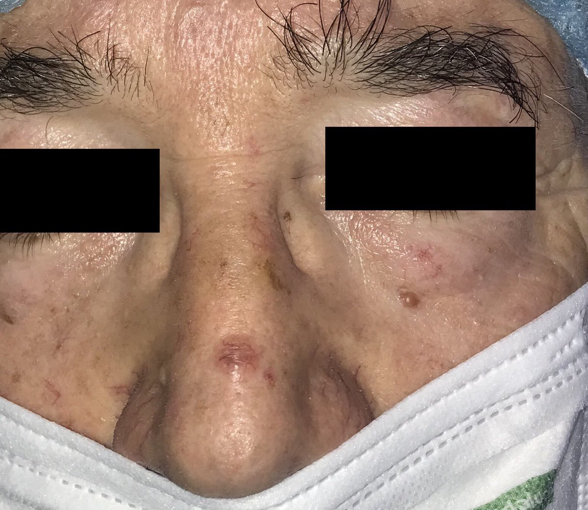 dermacrehuet's tweet photo. #surgery #room. Modified #Rintala #flap for #nasal #skin #cancer reconstruction #dermatology #oncology #aesthetic #CordobaEsp #BasalCellCarcimoma #carcinoma @aedv_es  @AEDVAndalucia https://t.co/rRnqhY8ytp