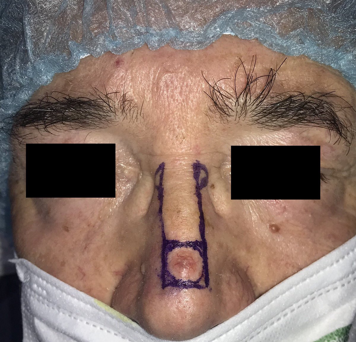 dermacrehuet's tweet photo. #surgery #room. Modified #Rintala #flap for #nasal #skin #cancer reconstruction #dermatology #oncology #aesthetic #CordobaEsp #BasalCellCarcimoma #carcinoma @aedv_es  @AEDVAndalucia https://t.co/rRnqhY8ytp