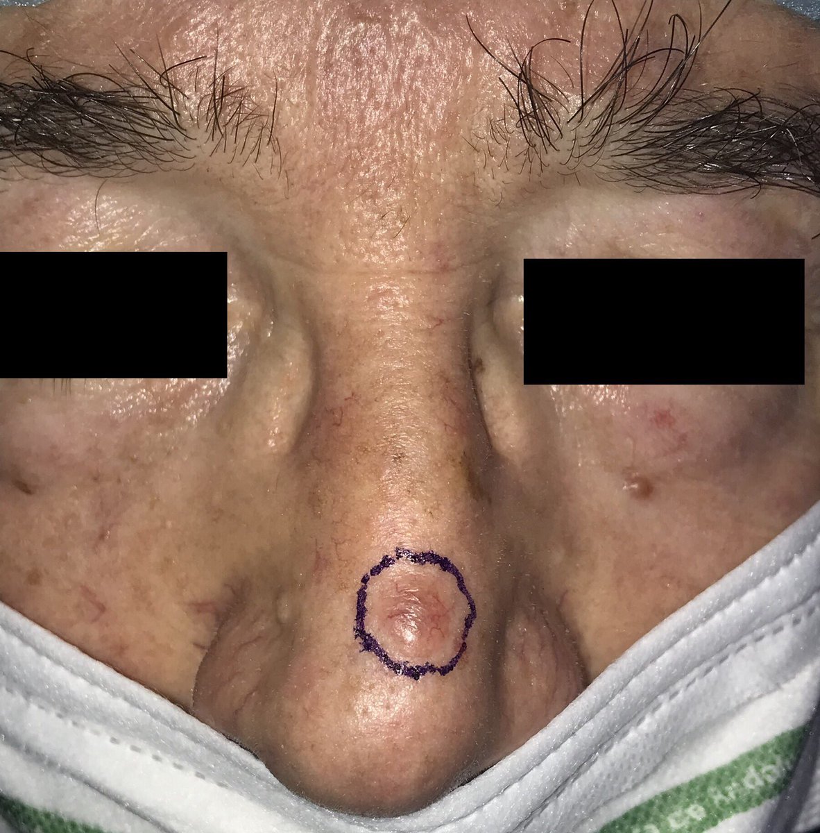 dermacrehuet's tweet photo. #surgery #room. Modified #Rintala #flap for #nasal #skin #cancer reconstruction #dermatology #oncology #aesthetic #CordobaEsp #BasalCellCarcimoma #carcinoma @aedv_es  @AEDVAndalucia https://t.co/rRnqhY8ytp