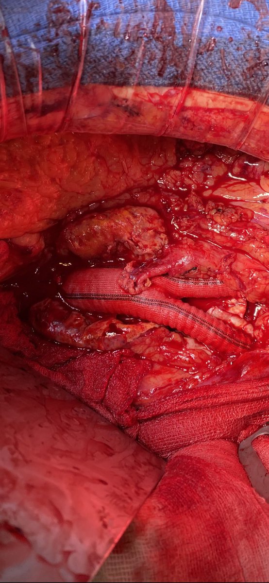 Depending on the length, you can reimplant IMA in the body or in the left branch of your bifurcated Dacron