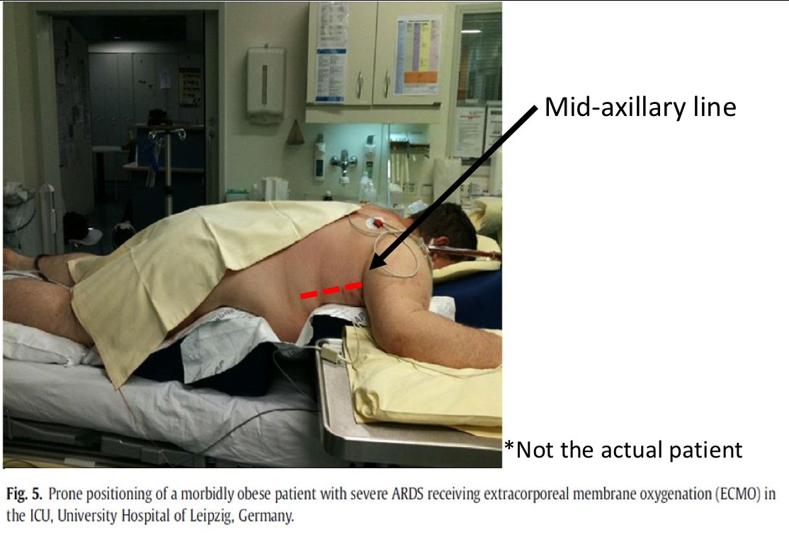 aki-in-young-pt-with-morbid-obesity-on-mechanical-ventilation-and-prone