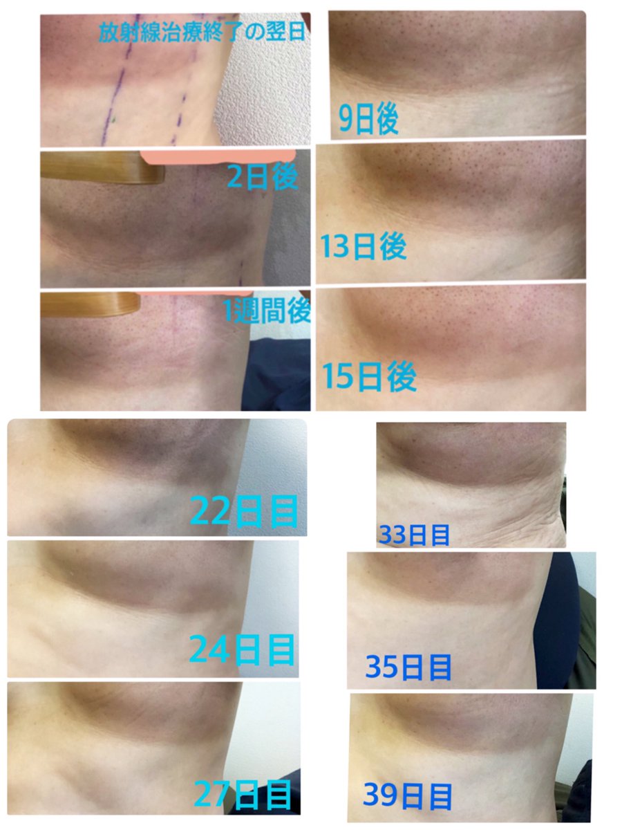 伽仍かの 乳がんと借金 On Twitter 乳がん放射線治療終了から5週間が過ぎた だいぶ肌も柔らかくなって ザラつきも治まり 色も落ち着きつつある 動かない時のジリジリ痛みが気になる 乳がん放射線治療後の肌炎症 そのほか経過観察 Https T Co Ckn4logxzw