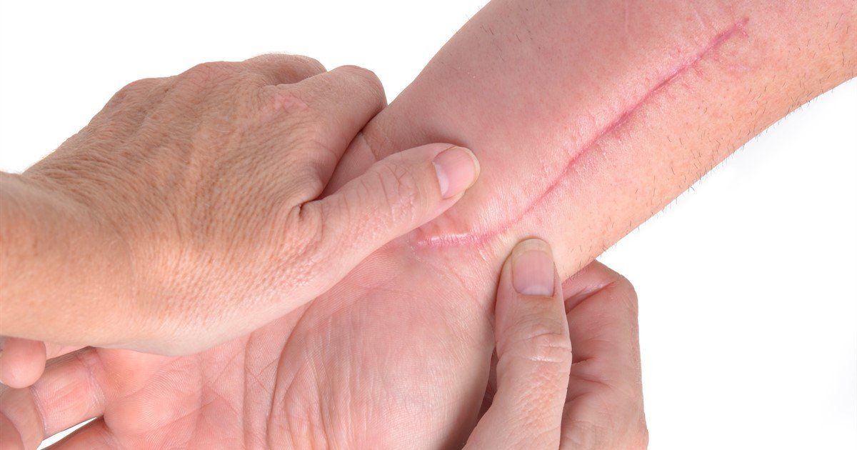 It's America's #NationalHealthySkinMonth! Find out about the benefits of scar massage from surgeon Mr <a href="/IoannisGoutos/">Ioannis Goutos</a> buff.ly/2IRUc96