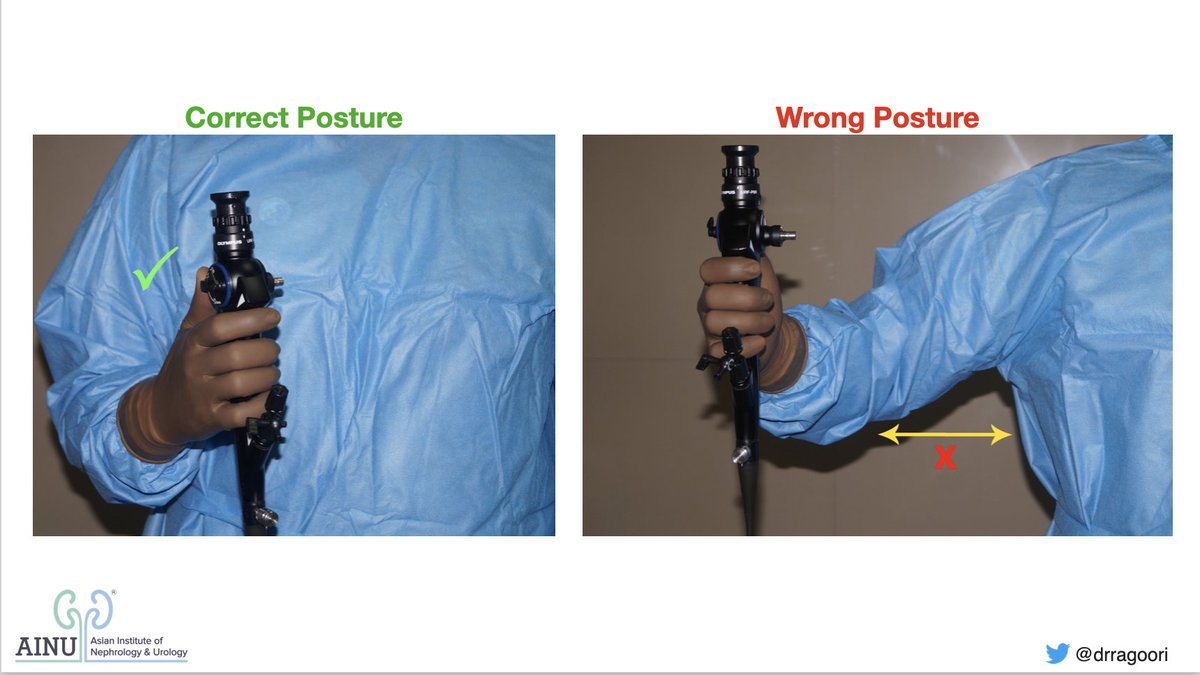 drragoori's tweet photo. Ergonomics in #RIRS: The Posture
✅ Hand close to the chest, Elbow close to body &amp; Shoulder dropped - keeps you comfortable
❌ Hand away from the chest, Elbow far from the body &amp; Shoulder raised - tires you fast
@OTRAXER @GuidoGiusti @drkemalsarica @so_uro @DocGauhar @endouro https://t.co/8FzrwxA5Gi