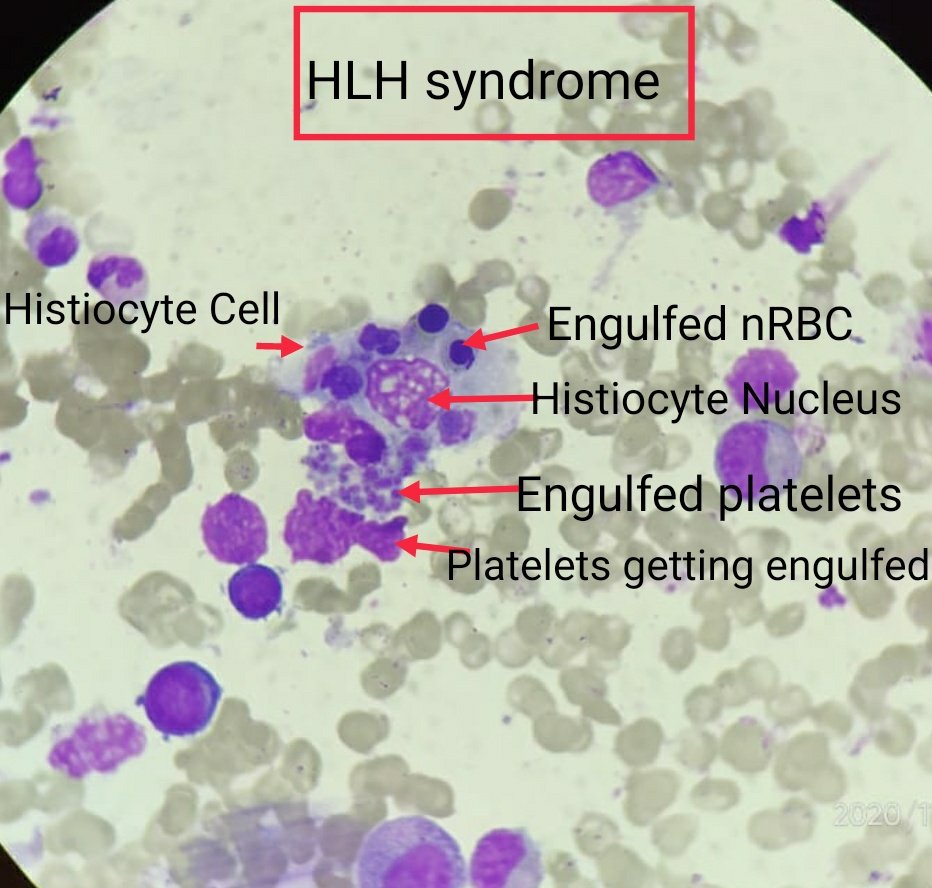 LangoteAmit's tweet image. A picture (slide) speaks a thousand words.
This one slide summarizes what HLH is all about.

It&apos;s amazing to see  platelets, RBC being eaten by the Histiocyte cell.
#Pathologyisamazing
#HLHSyndrome
