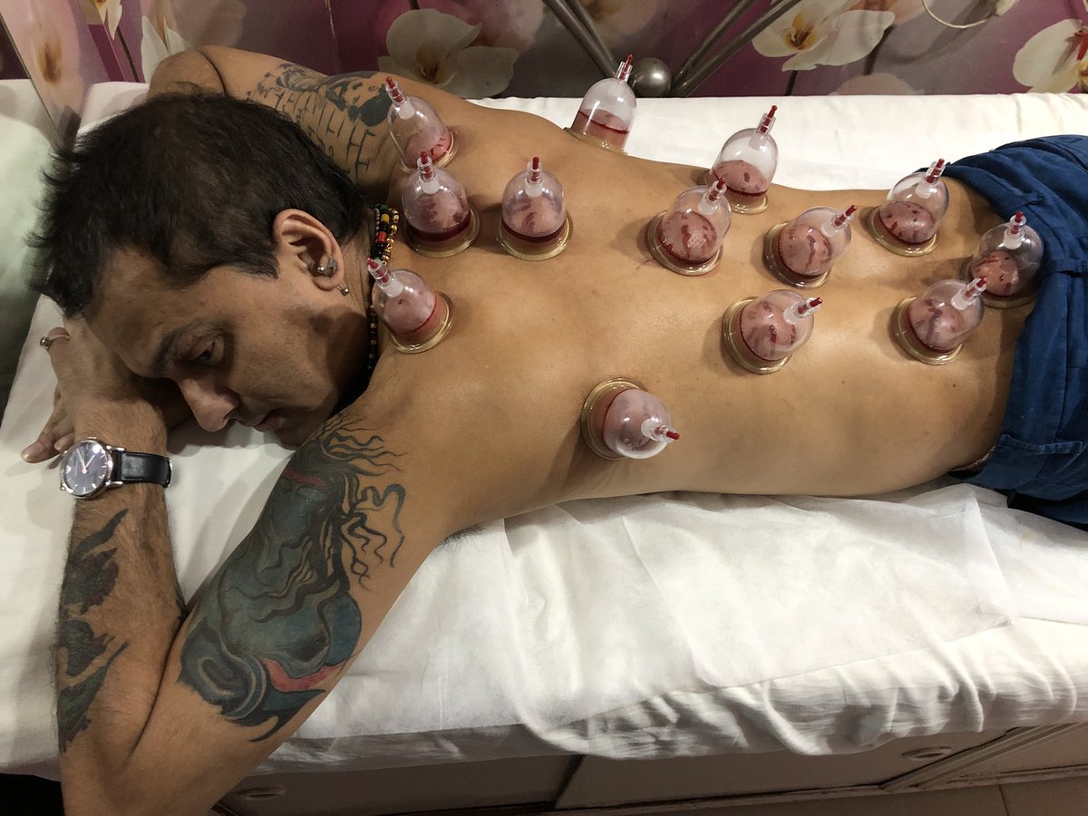 Had cupping therapy.great experience