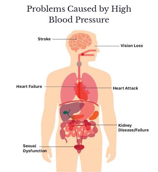 If I start taking tablets for high BP, will I get addicted/dependent on medicine? - very common concern. The question is wrong. The question should be is there a way to get rid of high blood pressure and stop medicine? Yes in some instances it may be possible.  #HighBloodPressure