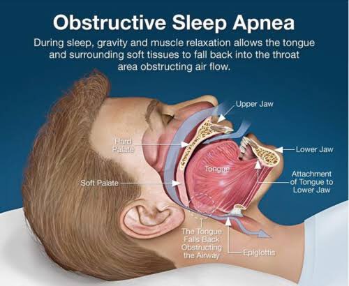 3. Obstructive sleep apnea (OSA) - too much snoring in night and low oxygen levels can lead to high BP. Common in overweight individuals with thick short neck. Treating OSA by using CPAP/BIPAP machine to help breath or sometimes surgically can cure high BP.  #OSA