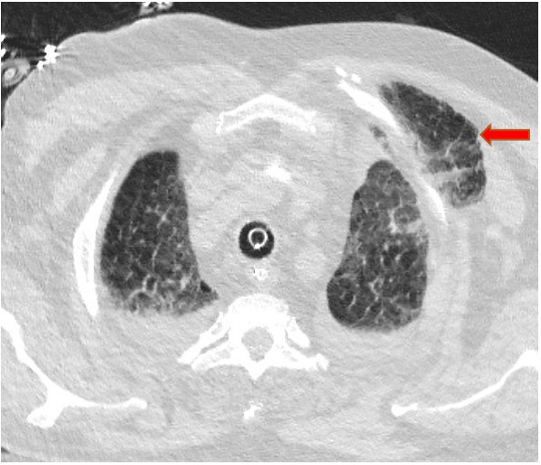 atscommunity's tweet photo. Can you answer this ATS Quick Hits? A 64-year-old male with a past medical history significant for COPD, diastolic congestive heart failure, OSA, and history of cardiac arrest requiring CPR, presented to the hospital due to shortness of breath. See more: https://t.co/4LUuwImxIy https://t.co/KT9Upik3tx