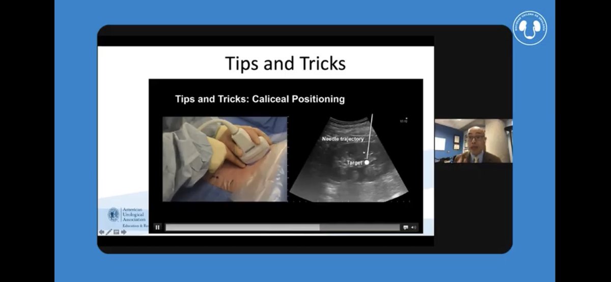 Esteban_Acuna_G's tweet image. Great talk @thomaschi8  in #SCHU2020 excellents tips&amp;amp;trips #USguided #PCNL #XRayFree #XRayFreePuncture @Urolchi @filialendouro @CAU_URO @AmerUrological @Uroweb @gaston_astroza @VicentiniUro @IbarluzeaGaspar @jianxingli_CN @PabloNContreras @MSGONZALEZURO