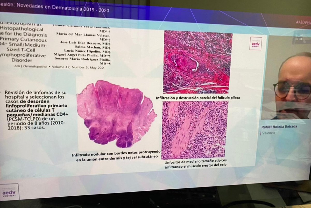 Novedades en dermatopatologia en el congreso nacional de dermatologia 2020. El Dr Rafael Botella  <a href="/RafaBotella/">Rafael Botella</a> contándonos los hallazgos histopstologicos en el dersorden linfoproliferativo CD4 de células pequeña/medianas.