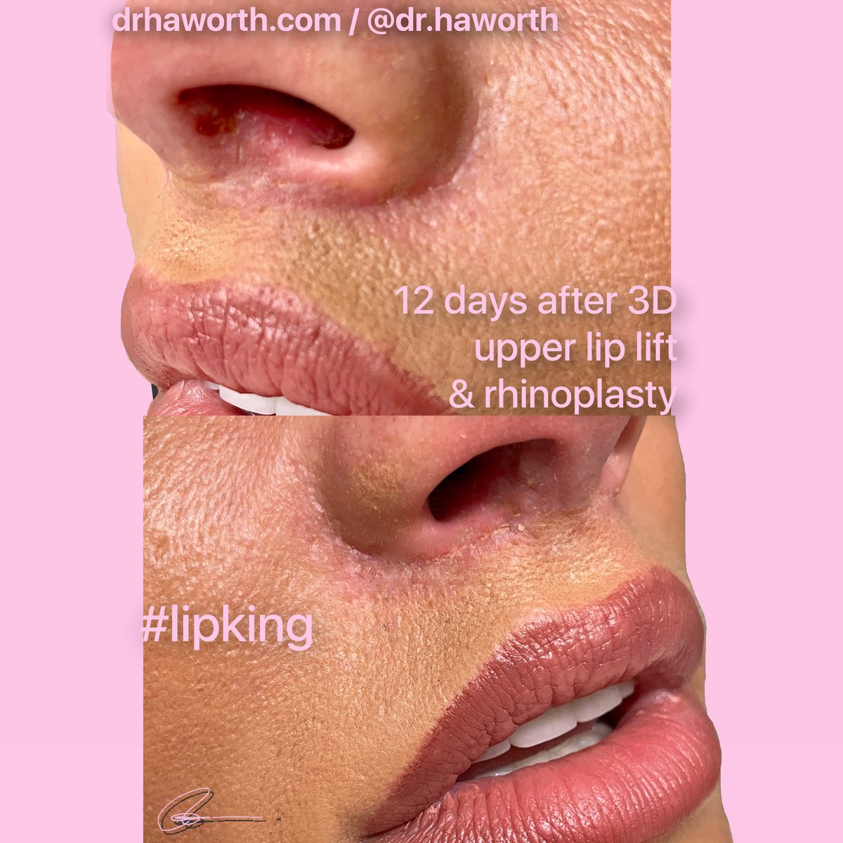This is the 8th 3-𝐃 𝐔𝐏𝐏𝐄𝐑 𝐋𝐈𝐏 𝐋𝐈𝐅𝐓 (my new variant of the 00S principal). It provides the same longevity &amp; beauty as my Orbicularis Oris suspension technique, but reducing recovery time by half while providing even better results! #DrHaworth 

DrHaworth.com