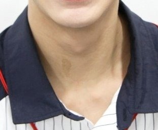 yuto (pentagon) and the birthmark on his neckalso: moles