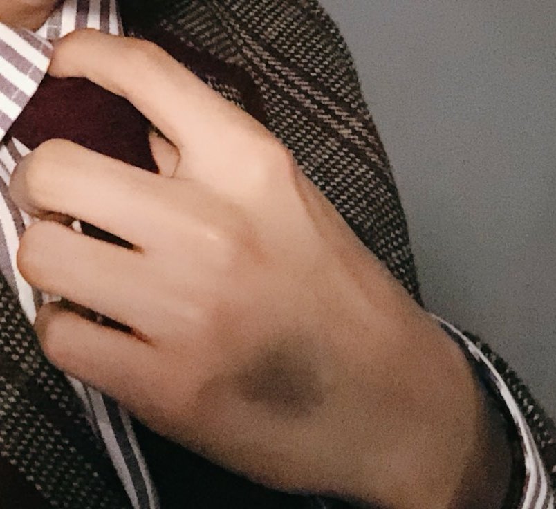 renjun (nct) and the birthmark on his hand, which looks a bit like a bruise