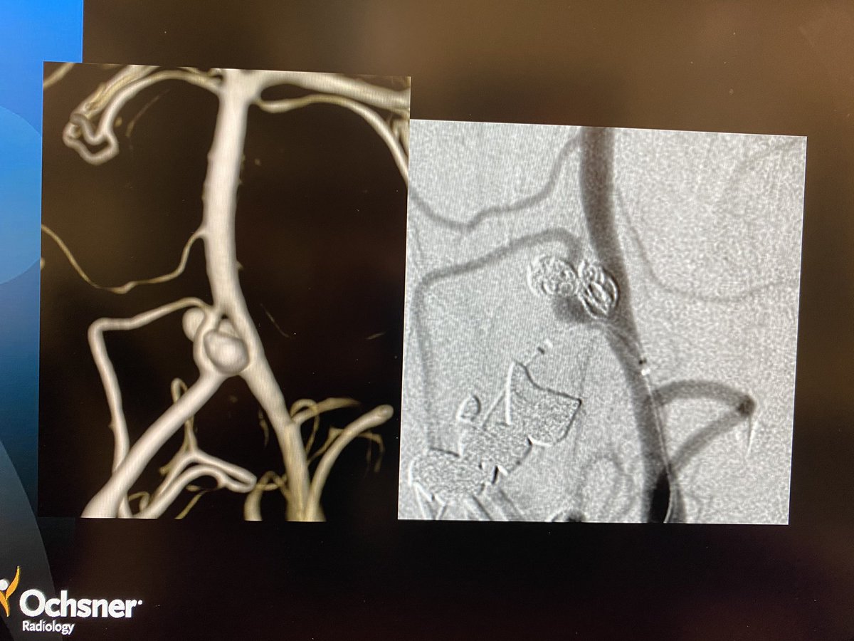 Body / Neurointerventional Med Student Symposium today <a href="/OchsnerRads/">Ochsner Radiology</a> Great engagement by all 👍🏼<a href="/JoshuaAHirsch/">Josh Hirsch</a> <a href="/bayouteazy/">Tyler Sandow</a> @JuanGimenezIRAD <a href="/denniskaymd/">Dennis Kay</a> <a href="/UqoRad/">UQ Ochsner Radiology Interest Group</a> <a href="/futureradres/">Future Radiology Residents</a> <a href="/SIRRFS/">SIR RFS</a> <a href="/SNISinfo/">SNIS Info</a>