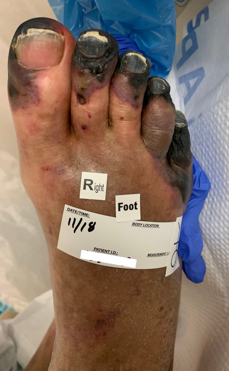 And those COVID Toes, appearing like thromboangiitis obliterans, are most likely due to this dysregulated excess extracellular serotonin, per below:(Image from a publicly shared post) https://pubmed.ncbi.nlm.nih.gov/8376917/ 