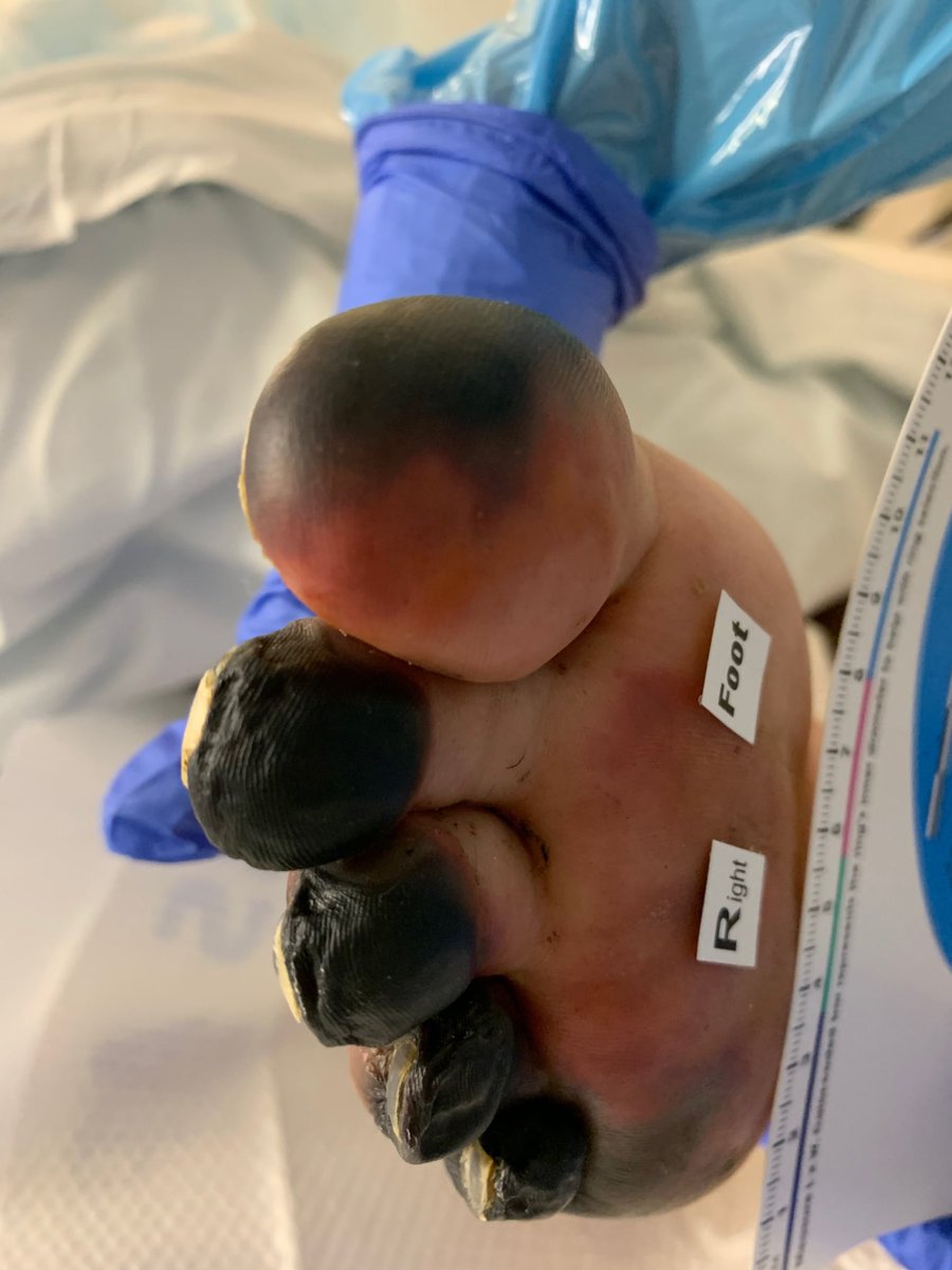 And those COVID Toes, appearing like thromboangiitis obliterans, are most likely due to this dysregulated excess extracellular serotonin, per below:(Image from a publicly shared post) https://pubmed.ncbi.nlm.nih.gov/8376917/ 