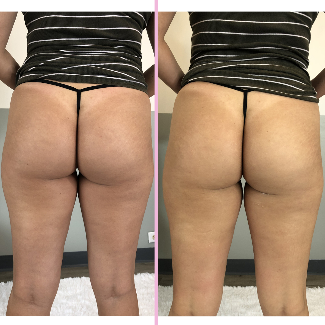 Renewuhawaii's tweet photo. Booty Work 🔥
.
.
.
#renewuhawaii #bodysculpting #ultrasoniccavitation #fatburing #fatloss #skintightening #beautyhawaii #fitnessjourney #bodygoals #fitnessgoals  #oahuhawaii https://t.co/QI1UbrVLDI