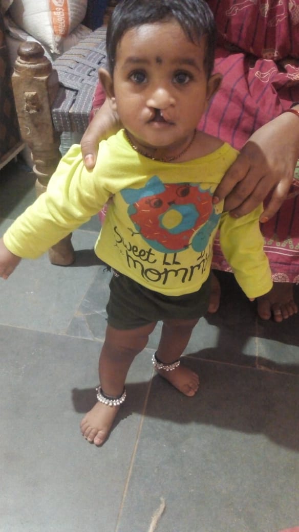 Narendr68081768's tweet photo. Dear Sonu Sood Ji,
I am Ravikumar from Telangana. I have one daughter as Sasivedha(10months baby). Unfortunately, she born with cleft lip disability. she needs surgery but I can't bear that surgery money. Please help her. Please contact us at 7702129617.#SonuSood  @SonuSood https://t.co/9qULQFcp8s