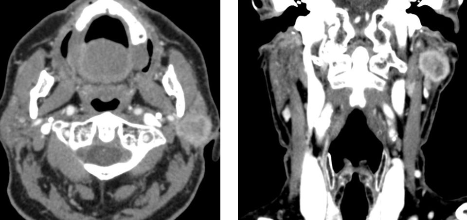 rubenpolo1979's tweet photo. Male 88 yo. #Parotidcarcinoma with facial nerve involvement. #Radicalparotidectomy with #neckdissection and CWU #mastoidectomy were performed. Facial nerve was surrounded by the tumor and was sacrificed. Collaboration Head and Neck/Otology divisions is essential https://t.co/nOzVVyphRZ