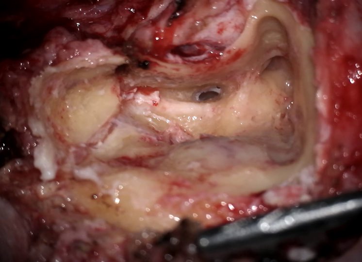 rubenpolo1979's tweet photo. Male 88 yo. #Parotidcarcinoma with facial nerve involvement. #Radicalparotidectomy with #neckdissection and CWU #mastoidectomy were performed. Facial nerve was surrounded by the tumor and was sacrificed. Collaboration Head and Neck/Otology divisions is essential https://t.co/nOzVVyphRZ