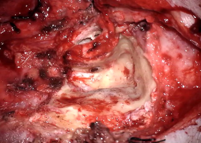 rubenpolo1979's tweet photo. Male 88 yo. #Parotidcarcinoma with facial nerve involvement. #Radicalparotidectomy with #neckdissection and CWU #mastoidectomy were performed. Facial nerve was surrounded by the tumor and was sacrificed. Collaboration Head and Neck/Otology divisions is essential https://t.co/nOzVVyphRZ