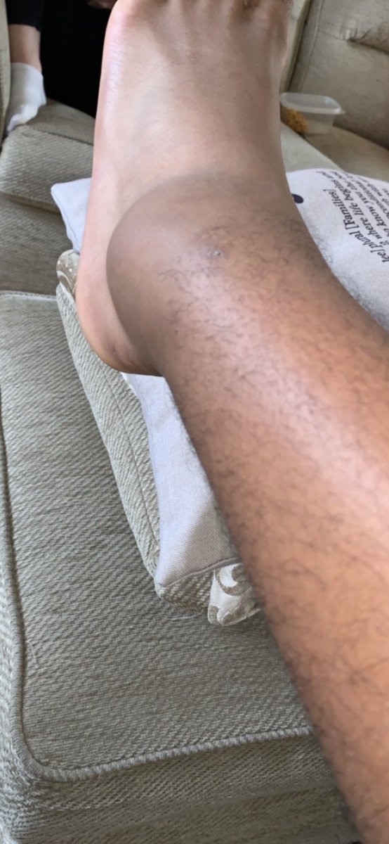 AdamOsbourne_3's tweet photo. Two dislocated shoulders and an ankle ligament in the space of a year🙃 yet another long road to recovery... https://t.co/0p6sseYIdQ