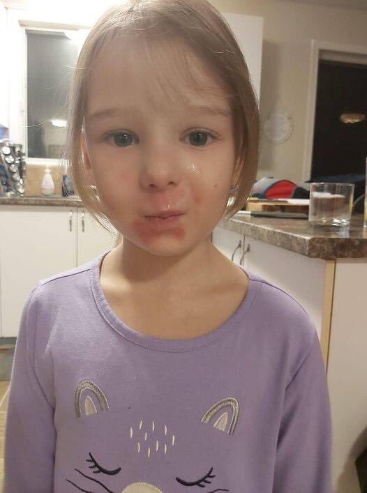 jipettes's tweet image. Le résultat du port du masque chez les enfants et il y en a également chez les adultes ! 
Surtout qu’il est inutile ! La CAQ et Trudeau responsables