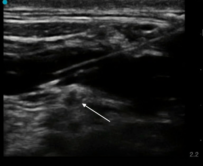 5/ In this case, a nerve bundle is seen! This reminds us of the importance of identifying and avoiding neighboring key structures, such as nerves. Nerve injury has been reported following central venous cannulation.  https://pubmed.ncbi.nlm.nih.gov/3047455/ 