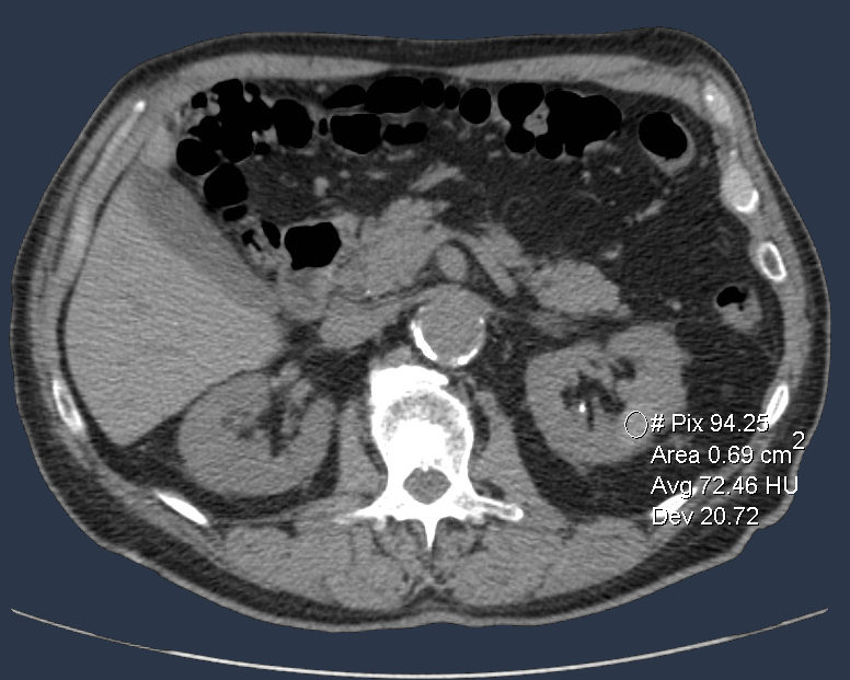 mharisinghani's tweet photo. On non contrast study; cyst with greater than 70 HU measurement is almost certainly a benign hemorrhagic cyst https://t.co/DPXb1PsrNU