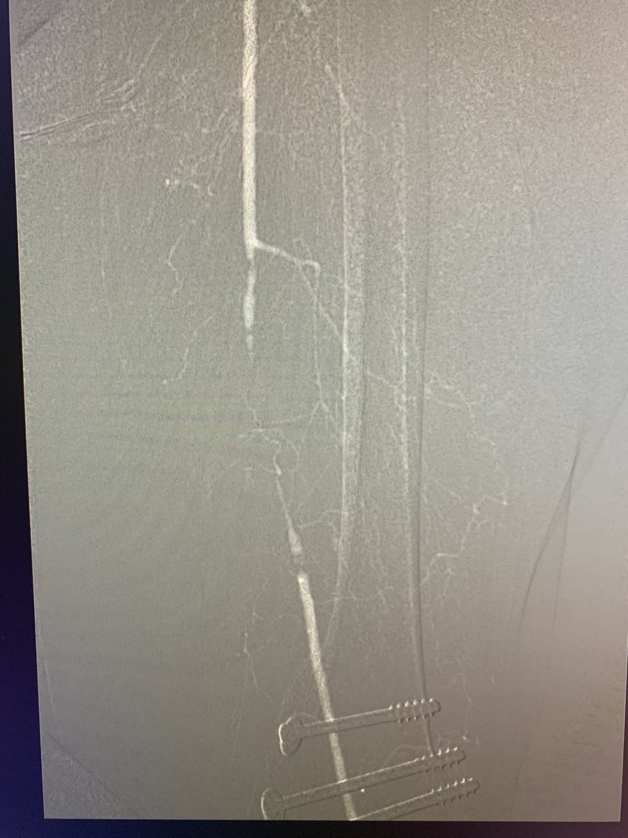banderaldhafery's tweet photo. Co2 guided SFA stenting in #CLI patient with non healing foot ulcer using #angiodroid co2 injector . No contrast was used at all.#irad #CLI #WorldDiabetesDay https://t.co/B6wBNmJMPe