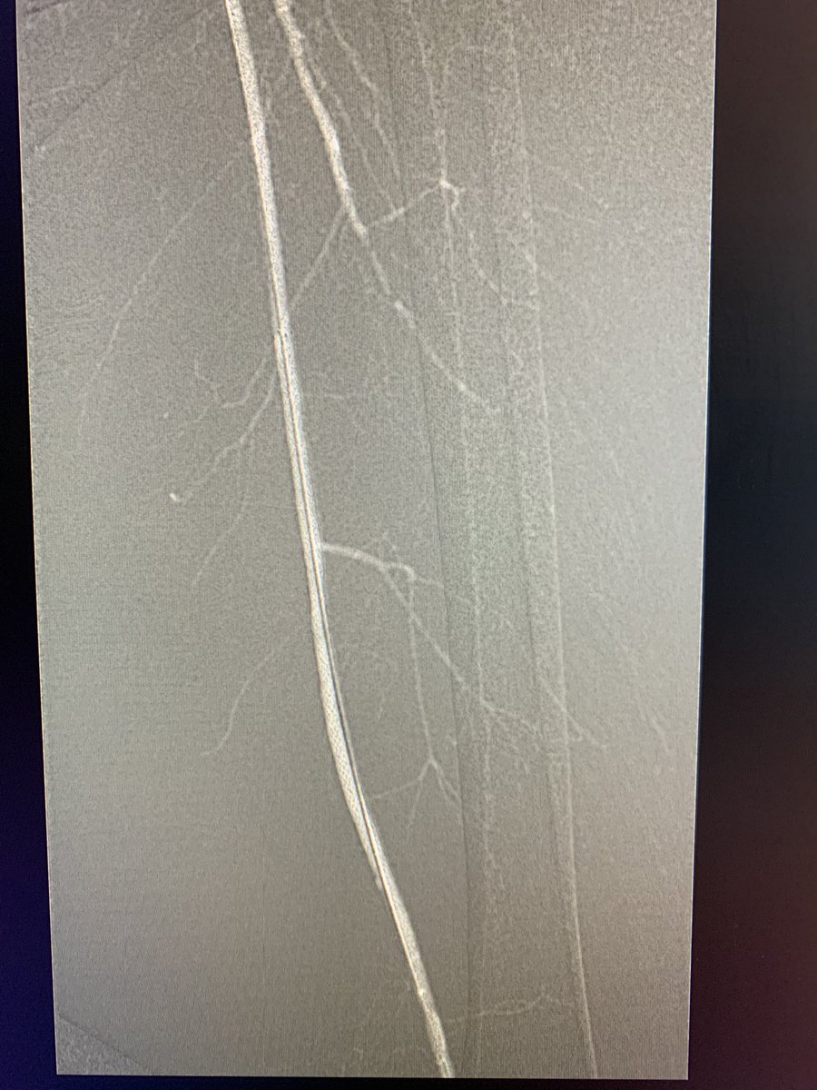 banderaldhafery's tweet photo. Co2 guided SFA stenting in #CLI patient with non healing foot ulcer using #angiodroid co2 injector . No contrast was used at all.#irad #CLI #WorldDiabetesDay https://t.co/B6wBNmJMPe