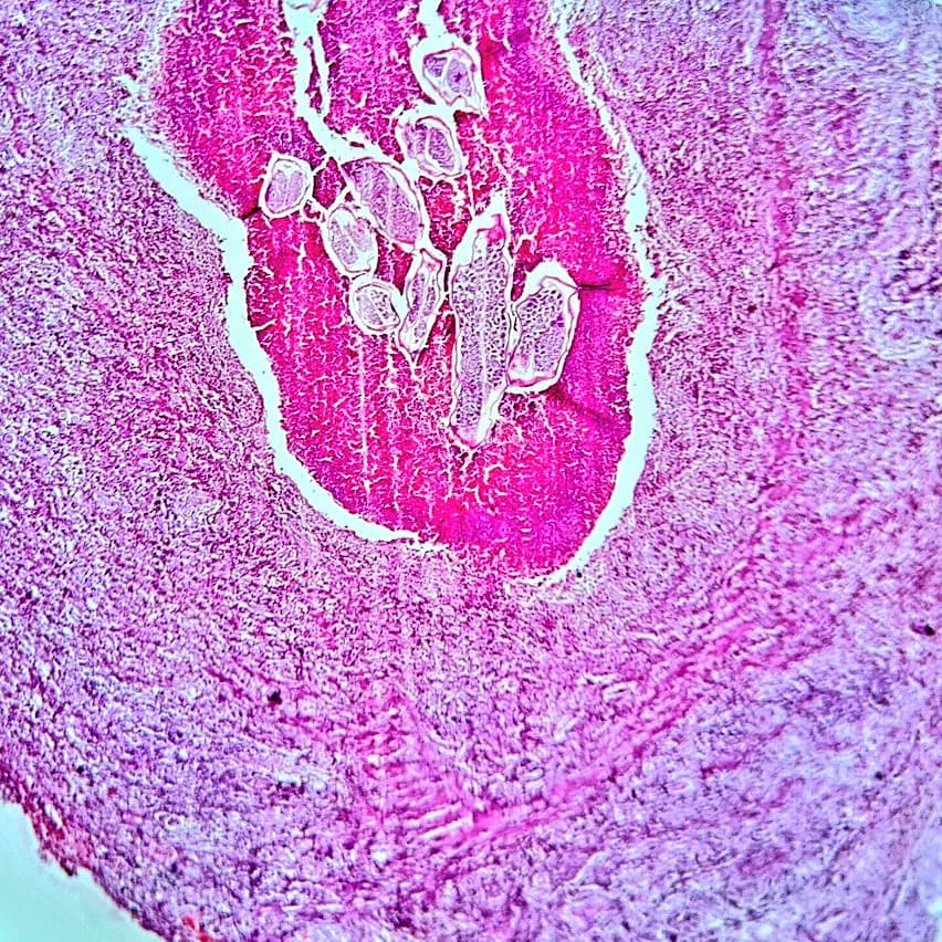 pkmadridista's tweet photo. I think only females should have the right to decide regarding abortion till its a case of microfilariae in an Inguinal node like the one below
It turned out to be Wuchereria bancrofti which is sheathed and the nucleus doesnt reach till the tip
#PathTwitter #pathbug https://t.co/N4713WBqV1