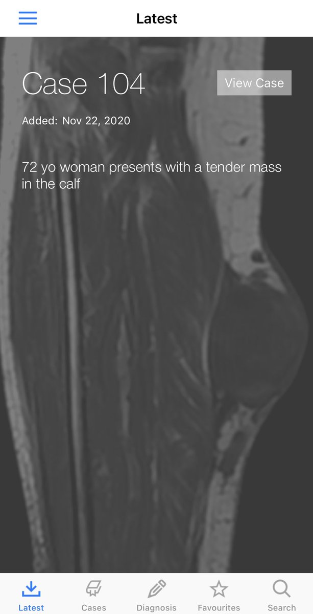 BoSTT_app's tweet photo. Case 104 - superficial soft tissue tumour. Diagnosis and learning point @BoSTT_app 
#FOAMed #FOAMrad #radiology #MSKRad #pathology #BSTpath #sarcoma https://t.co/1g1E1THTj4