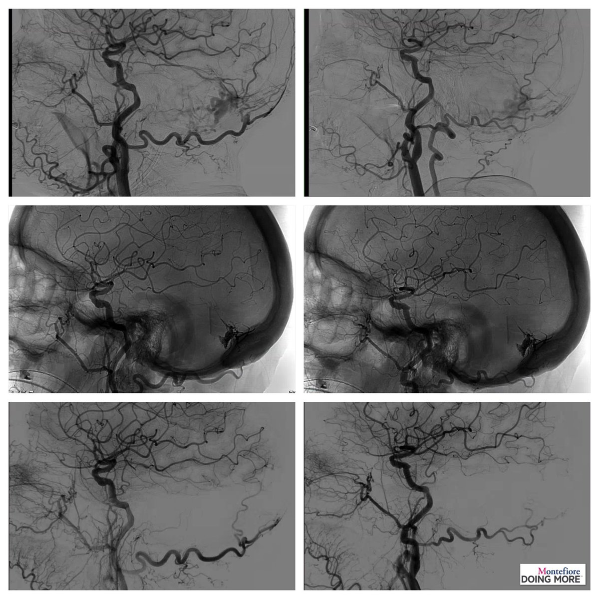 DavidAltschulMD's tweet photo. #duralAVF with the mini-scepter @MV_Terumo #onyx embolization. Amazing device tracked way out in the MMA however still had a way to go to get onyx into the fistulous sac. No worries, inflate the balloon and get the job done. Another AVF cured @MontefioreNYC #neurosurgery https://t.co/gxswDskkNi
