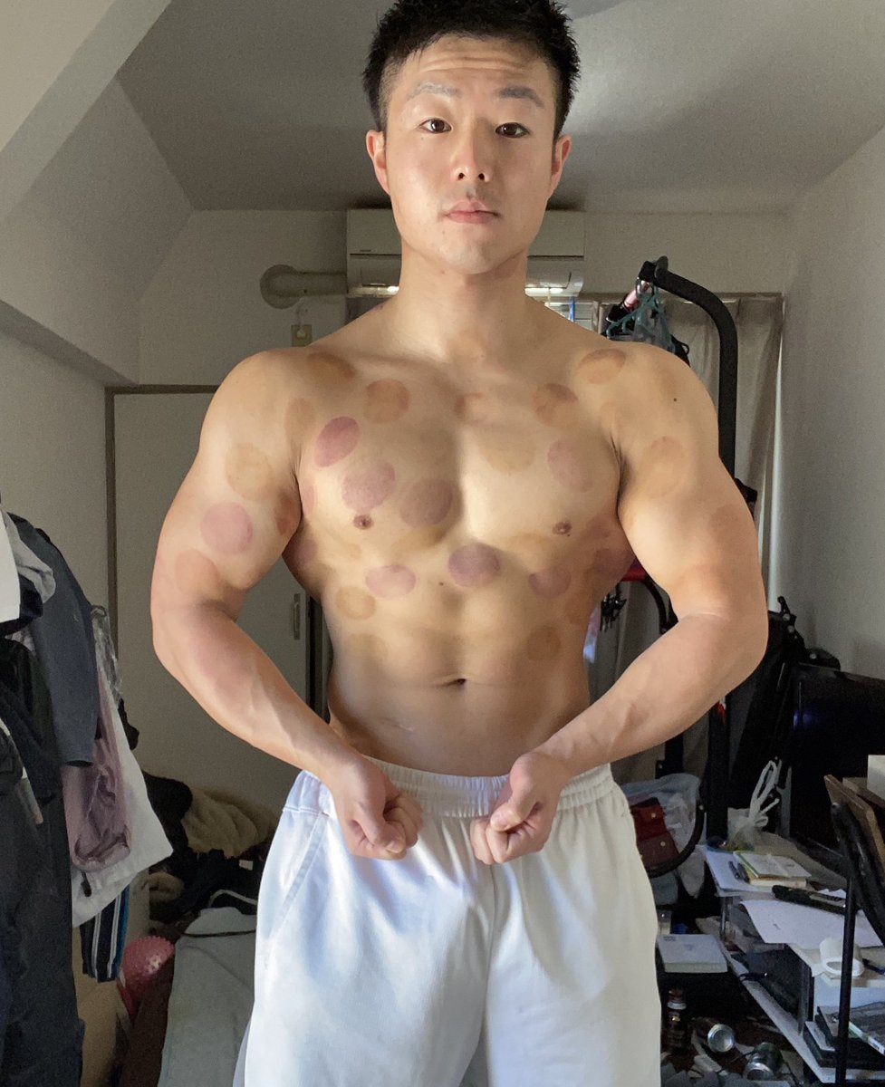 ちんあなご On Twitter カッピング跡がもうほんとに 北斗の拳知らんけど南斗狐鷲拳よりエグいて まだ皮膚が硬いところにガラスの吸い玉が付きにくいからシリコンのやつ頼んだいた これからこれから なんだか今日振れる気がする