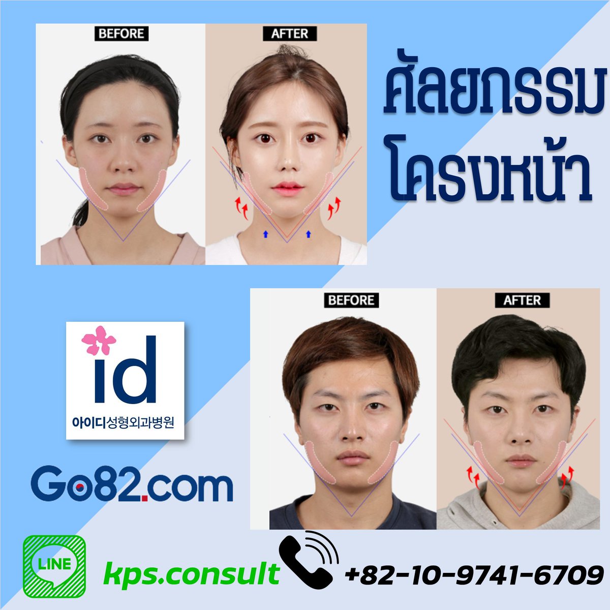 Go82Th's tweet image. ⚡️#โรงพยาบาลไอดี⚡️
ไว้ใจโรงพยาบาลไอดีมีเทคนิคที่จะทำให้ใบหน้าได้รูป เเละลัดส่วนที่เป็นธรรมชาติตามที่คุณต้องการ❗️❗️😀😀😀
ปรึกษาฟรี ติดต่อได้จร้า~
#ศัลยกรรม #ศัลยกรรมใบหน้า #ศัลยกรรมเกาหลี #ศัลกรรมจมูก #ศัลยกรรมความงาม #ศัลกรรมตา #ศัลยกรรมโครงหน้า