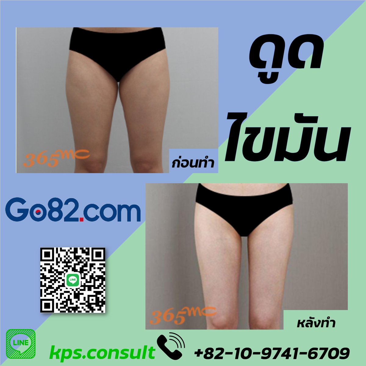 Go82Th's tweet image. ✨ #โรงพยาบาล365mc ✨
โรงพยาบาลดูดไขมัน ที่เห็นผลได้รวดเร็วภายใน 3เดือน 👏
ผลลัพท์ที่ยอดเยี่ยมมากกว่สการไดเอ็ด

#ศัลยกรรม #ศัลยกรรมความงาม #ศัลยกรรมเกาหลี  #ศัลยกรรมพลิกชีวิต #ศัลยกรรมดูดไขมัน #ดูดไขมัน #ดูดไขมันหน้าท้อง #ดูดไขมันทั้งตัว #ปรึกษา #รีวิวศัลยกรรม #เกาหลี #หุ่นสวย